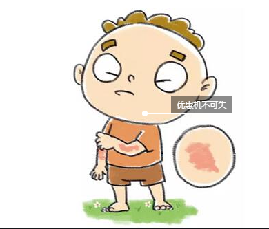 少年儿童患特应性皮炎 少年儿童患特应性皮炎